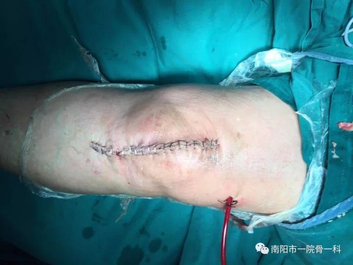 微创让膝关节置换不那么可怕:南阳市第一人民医院骨一